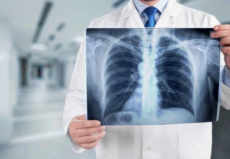 Флюорография как способ защитить лёгкие: зачем проходить обследование каждый год